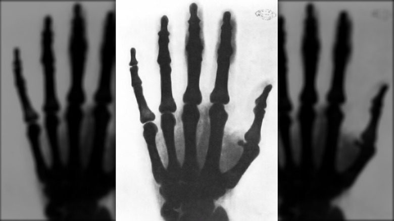 Рентгеновский снимок руки Николы Теслы