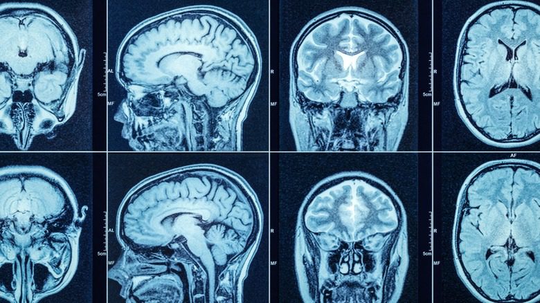 Рентгеновский снимок человеческого мозга